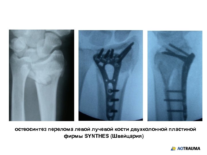 Перелом руки со смещением сколько носить. Остеосинтез перелома лучевой кости пластиной. Остеосинтез ДМЭ лучевой кости. Остеосинтез диафизарного перелома лучевой кости. Остеосинтез дистального метаэпифиза лучевой кости пластиной.