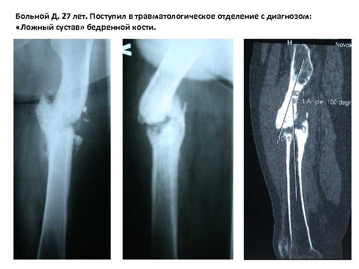 Ложный сустав после перелома плечевой кости фото