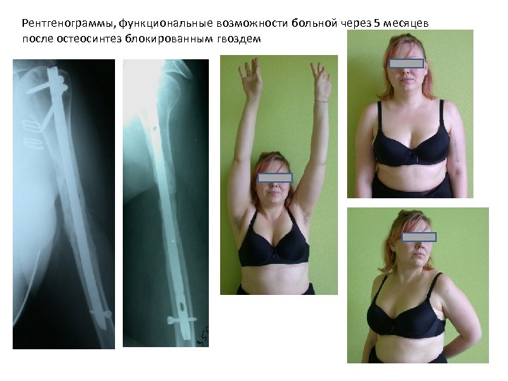 Рентгенограммы, функциональные возможности больной через 5 месяцев после остеосинтез блокированным гвоздем 