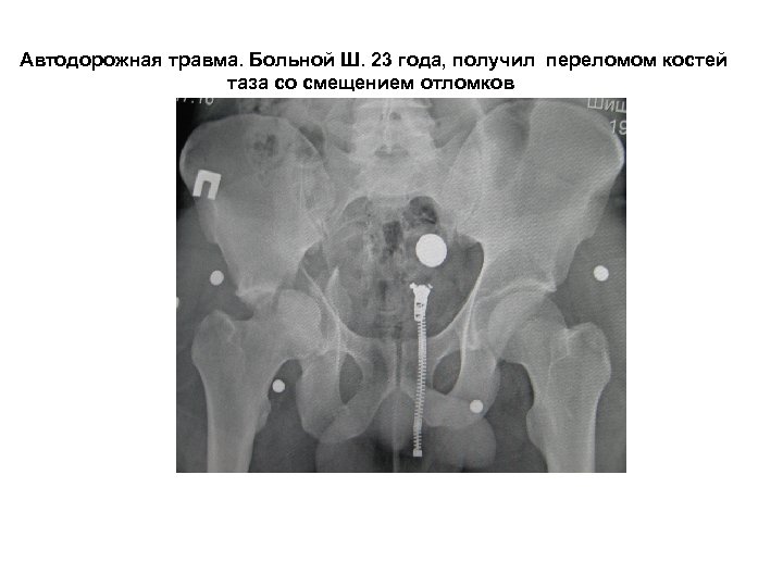 Автодорожная травма. Больной Ш. 23 года, получил переломом костей таза со смещением отломков 