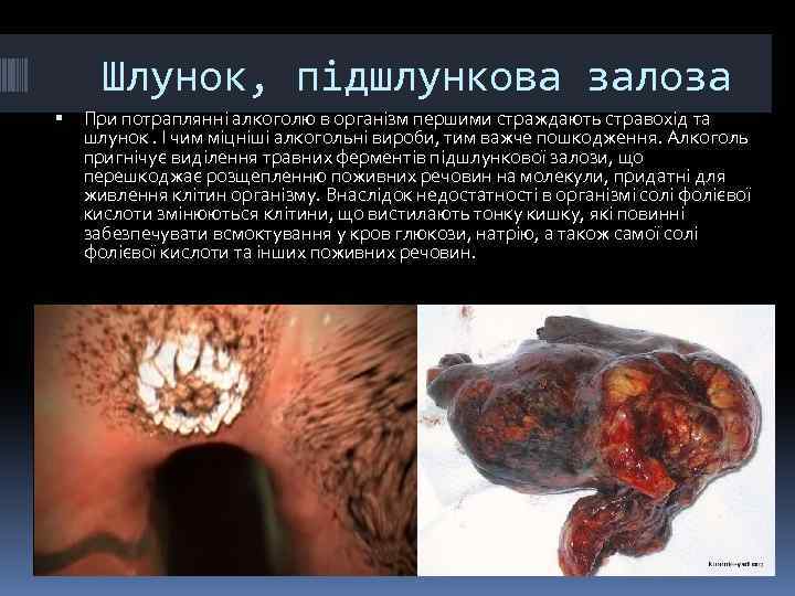 Шлунок, підшлункова залоза При потраплянні алкоголю в організм першими страждають стравохід та шлунок. І
