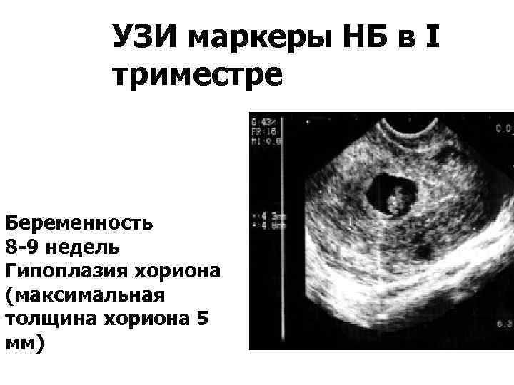 Отслойка 8 недель. Беременность 6 недель УЗИ хорион. Отслойка хориона в первом триместре УЗИ. Частичная отслойка хориона 7 недель. Отслойка в 5 недель беременности УЗИ.