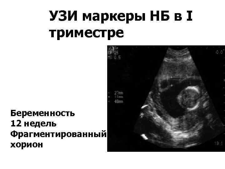 УЗИ маркеры НБ в I триместре Беременность 12 недель Фрагментированный хорион 