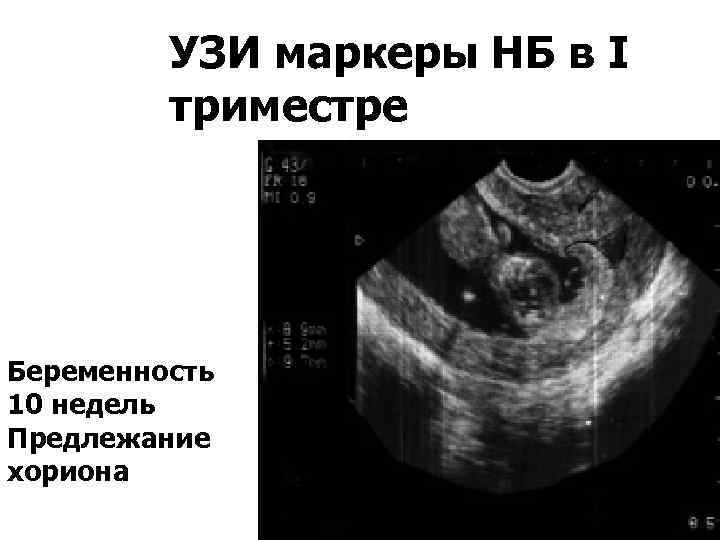 УЗИ маркеры НБ в I триместре Беременность 10 недель Предлежание хориона 