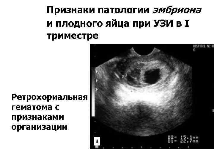 Отслойка на 6 неделе. УЗИ беременность 6 недель с гематомой. УЗИ В 5-6 недель беременности гематома. УЗИ 6 недель беременности отслойка плодного яйца. УЗИ 10 недель ретрохориальная гематома.