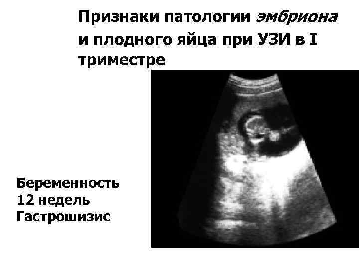 Признаки патологии эмбриона и плодного яйца при УЗИ в I триместре Беременность 12 недель