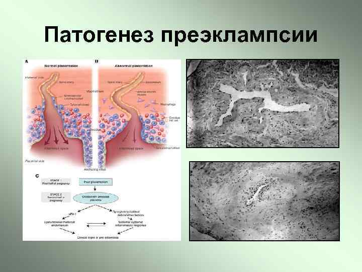 Патогенез преэклампсии 