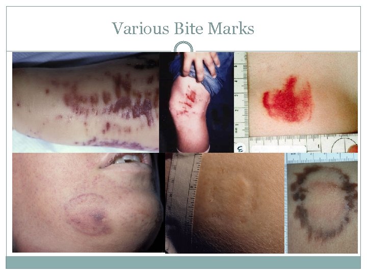 Various Bite Marks 