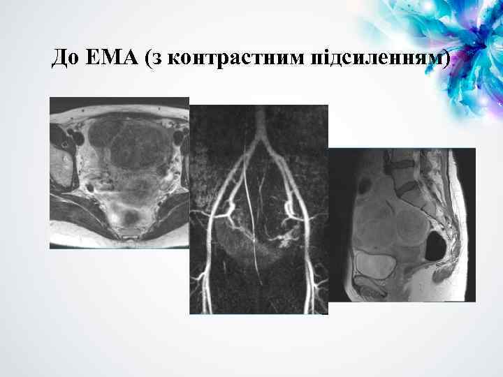 До ЕМА (з контрастним підсиленням) 