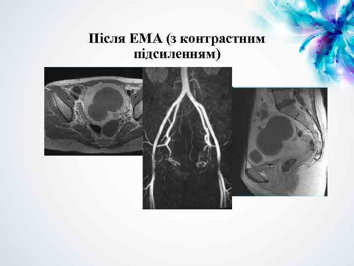 Після ЕМА (з контрастним підсиленням) 