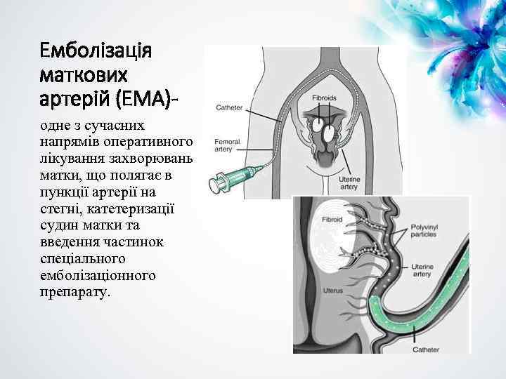 Емболізація маткових артерій (ЕМА)одне з сучасних напрямів оперативного лікування захворювань матки, що полягає в