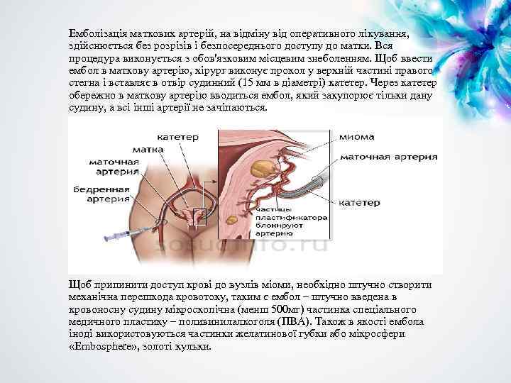 Емболізація маткових артерій, на відміну від оперативного лікування, здійснюється без розрізів і безпосереднього доступу