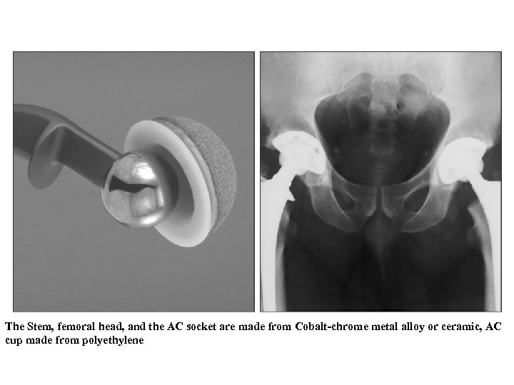 The Stem, femoral head, and the AC socket are made from Cobalt-chrome metal alloy