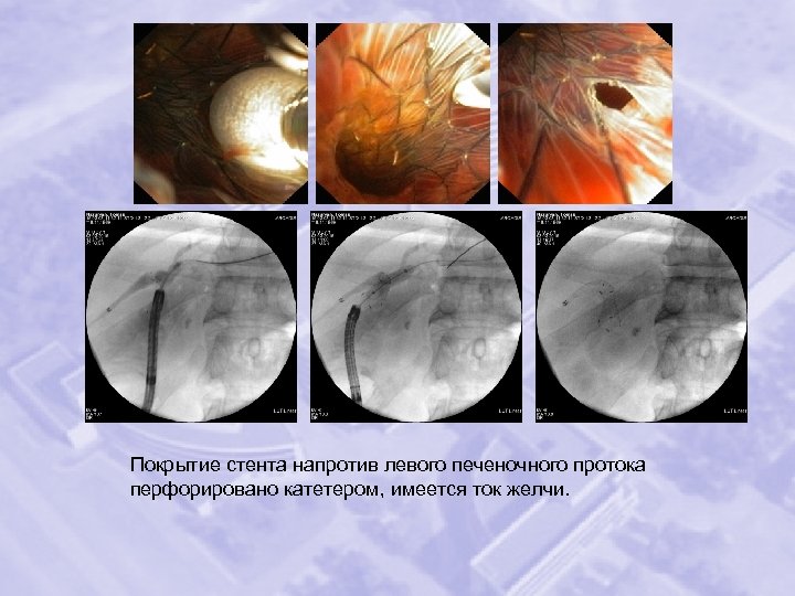 Покрытие стента напротив левого печеночного протока перфорировано катетером, имеется ток желчи. 