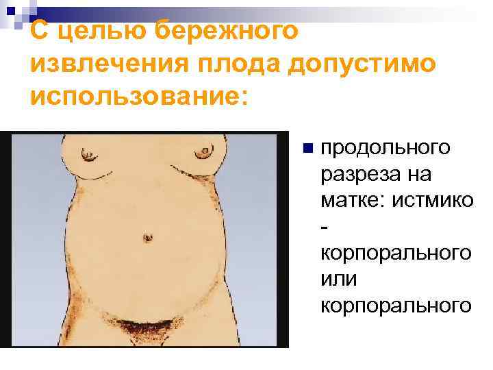 С целью бережного извлечения плода допустимо использование: n продольного разреза на матке: истмико корпорального
