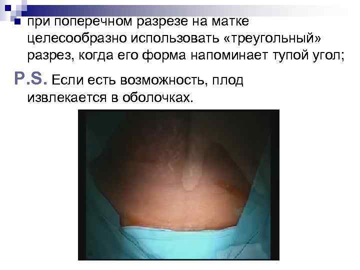 n при поперечном разрезе на матке целесообразно использовать «треугольный» разрез, когда его форма напоминает