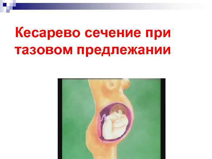 Кесарево сечение при тазовом предлежании 