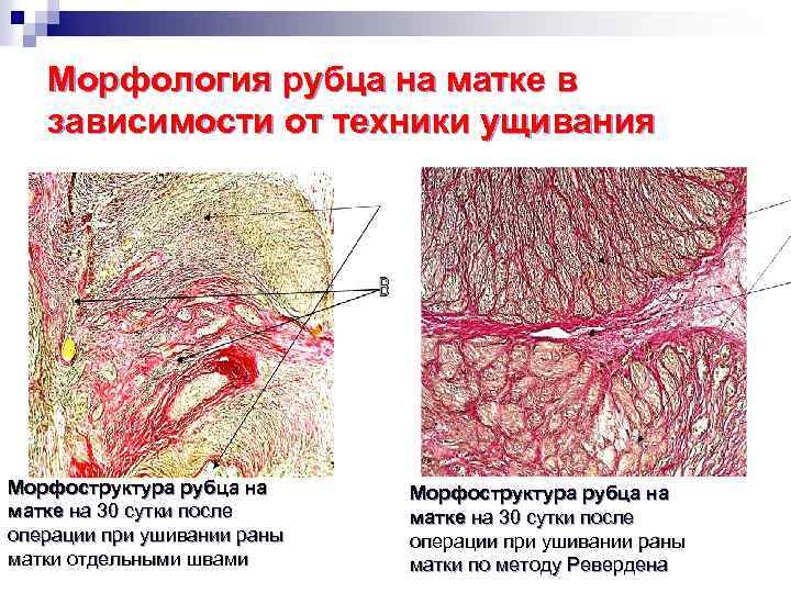 Морфология рубца на матке в зависимости от техники ущивания Морфоструктура рубца на матке на