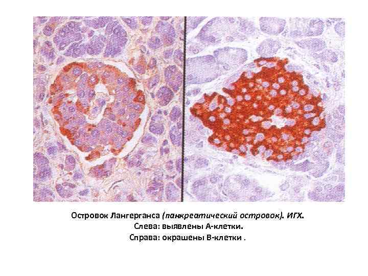 Островок Лангерганса (панкреатический островок). ИГХ. Слева: выявлены А-клетки. Справа: окрашены В-клетки. 