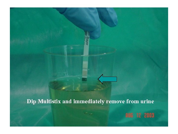 Dip Multistix Dip immediately remove from urine and Multistix and immediately remove from urine