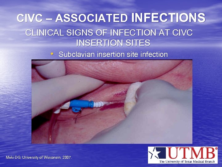 CIVC – ASSOCIATED INFECTIONS CLINICAL SIGNS OF INFECTION AT CIVC INSERTION SITES • Subclavian