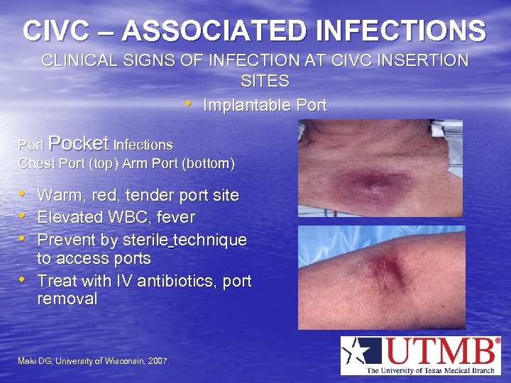 CIVC – ASSOCIATED INFECTIONS CLINICAL SIGNS OF INFECTION AT CIVC INSERTION SITES • Implantable