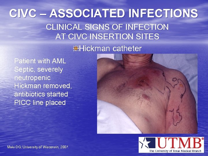 CIVC – ASSOCIATED INFECTIONS CLINICAL SIGNS OF INFECTION AT CIVC INSERTION SITES Hickman catheter