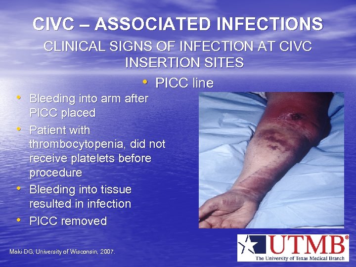 CIVC – ASSOCIATED INFECTIONS CLINICAL SIGNS OF INFECTION AT CIVC INSERTION SITES • PICC