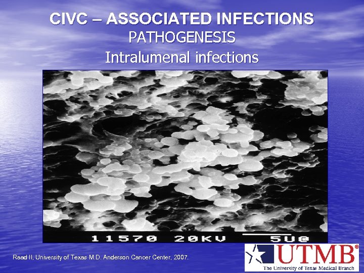 CIVC – ASSOCIATED INFECTIONS PATHOGENESIS Intralumenal infections Raad II, University of Texas M. D.