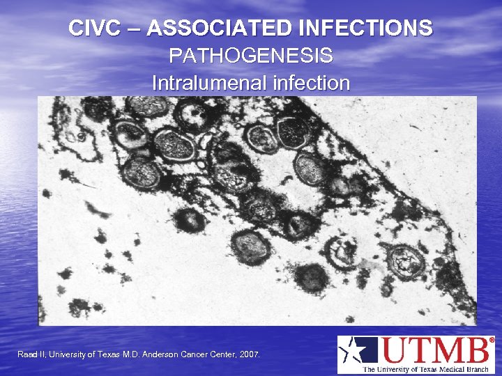 CIVC – ASSOCIATED INFECTIONS PATHOGENESIS Intralumenal infection Raad II, University of Texas M. D.