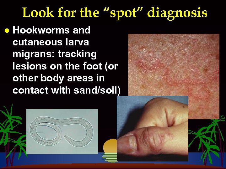 Look for the “spot” diagnosis l Hookworms and cutaneous larva migrans: tracking lesions on