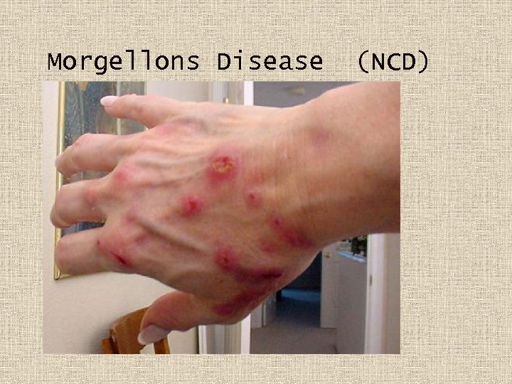 Morgellons Disease (NCD) 