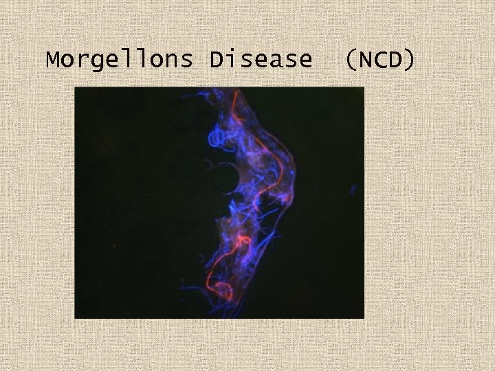 Morgellons Disease (NCD) 