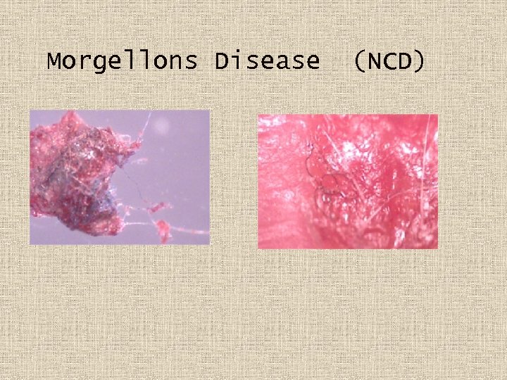 Morgellons Disease (NCD) 