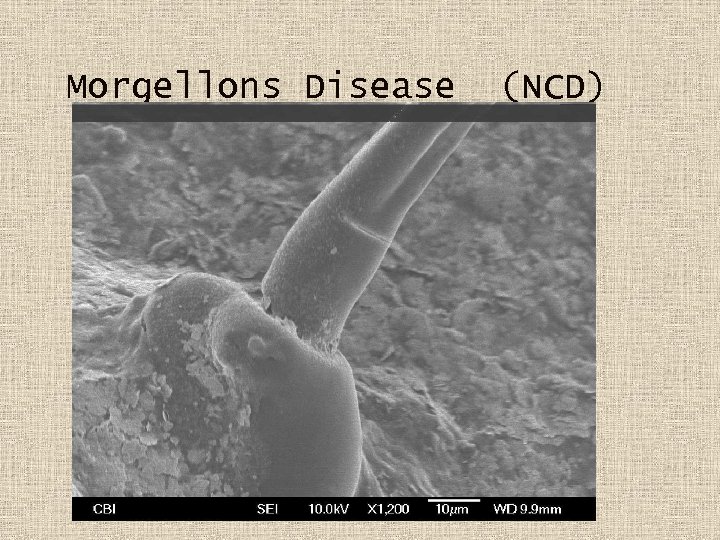 Morgellons Disease (NCD) 