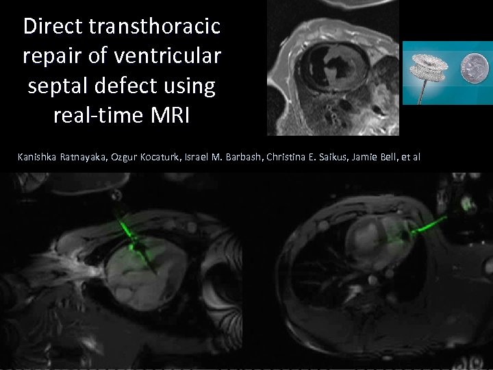 Direct transthoracic repair of ventricular septal defect using real-time MRI Kanishka Ratnayaka, Ozgur Kocaturk,