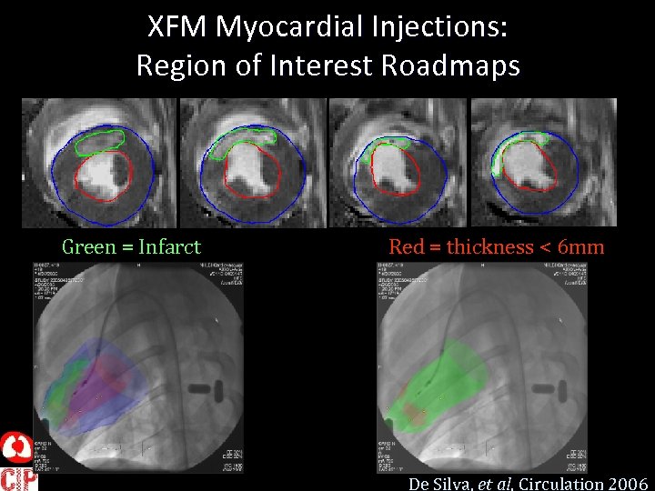 XFM Myocardial Injections: Region of Interest Roadmaps Green = Infarct Red = thickness <