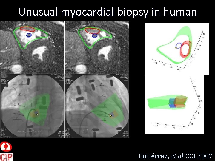 Unusual myocardial biopsy in human Gutiérrez, et al CCI 2007 