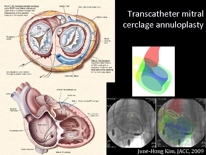 Transcatheter mitral cerclage annuloplasty June-Hong Kim, JACC, 2009 