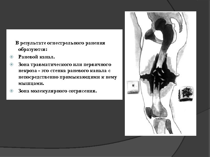 Зоны ранения. Зона первичного некроза при огнестрельном ранении. Зоны повреждения огнестрельной раны. Зоны повреждения при огнестрельной ране. Раневой канал при огнестрельном ранении.