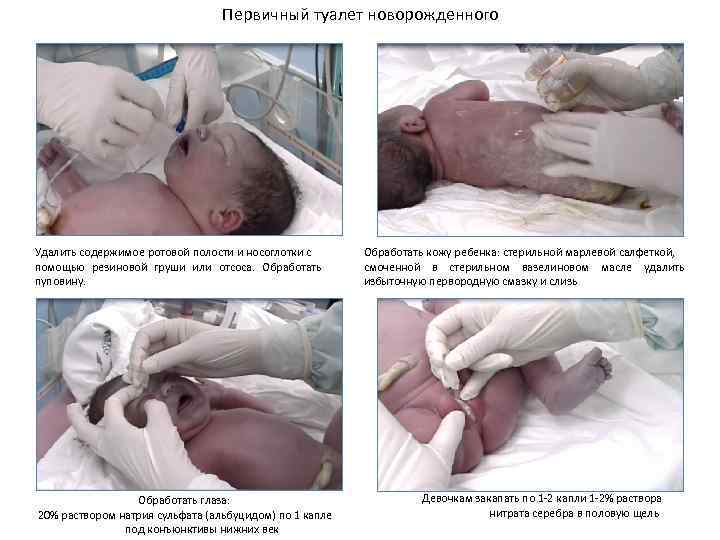Первичный туалет новорожденного Удалить содержимое ротовой полости и носоглотки с помощью резиновой груши или