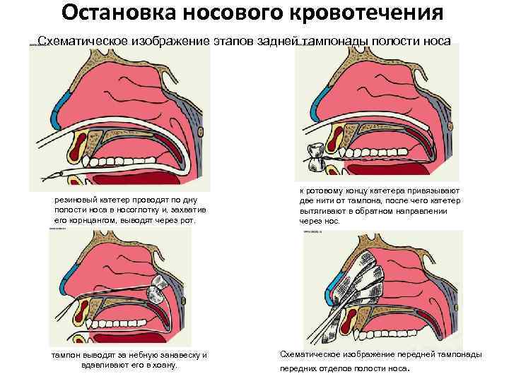 Остановка носового кровотечения Схематическое изображение этапов задней тампонады полости носа резиновый катетер проводят по