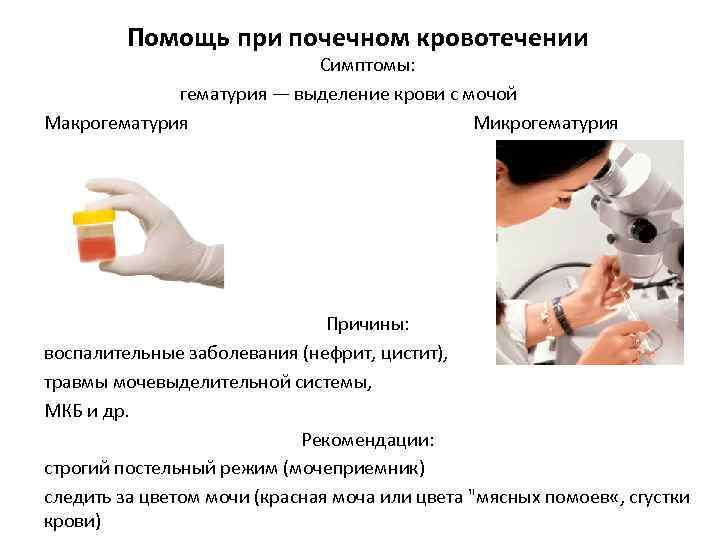 Помощь при почечном кровотечении Симптомы: гематурия — выделение крови с мочой Макрогематурия Микрогематурия Причины: