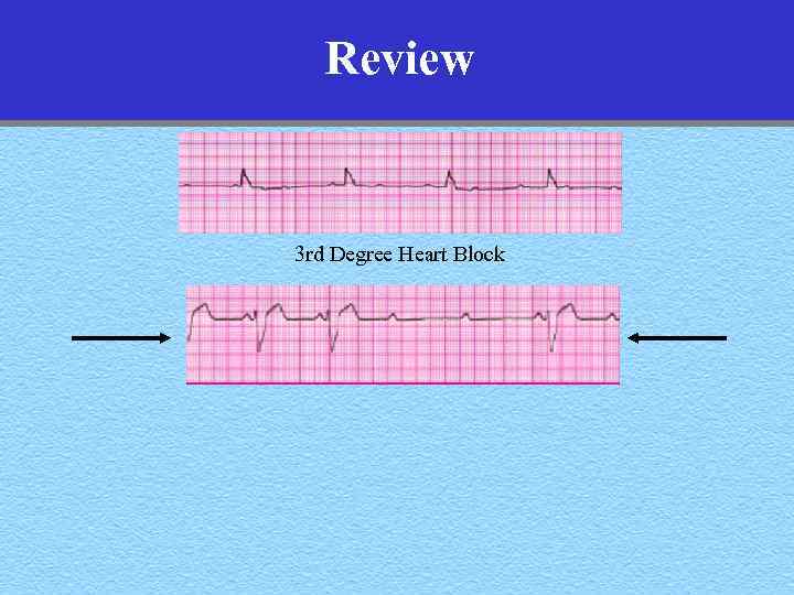 Review 3 rd Degree Heart Block 