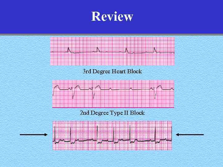 Review 3 rd Degree Heart Block 2 nd Degree Type II Block 