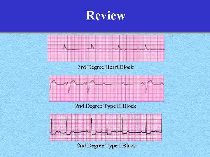 Review 3 rd Degree Heart Block 2 nd Degree Type II Block 2 nd