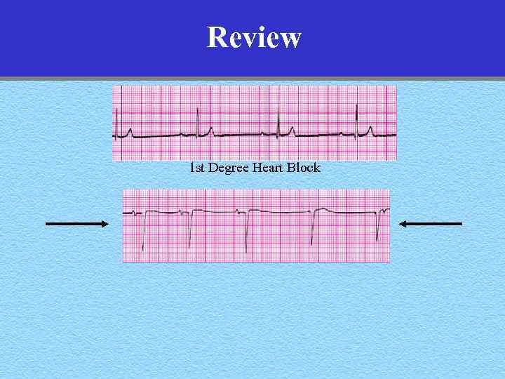 Review 1 st Degree Heart Block 