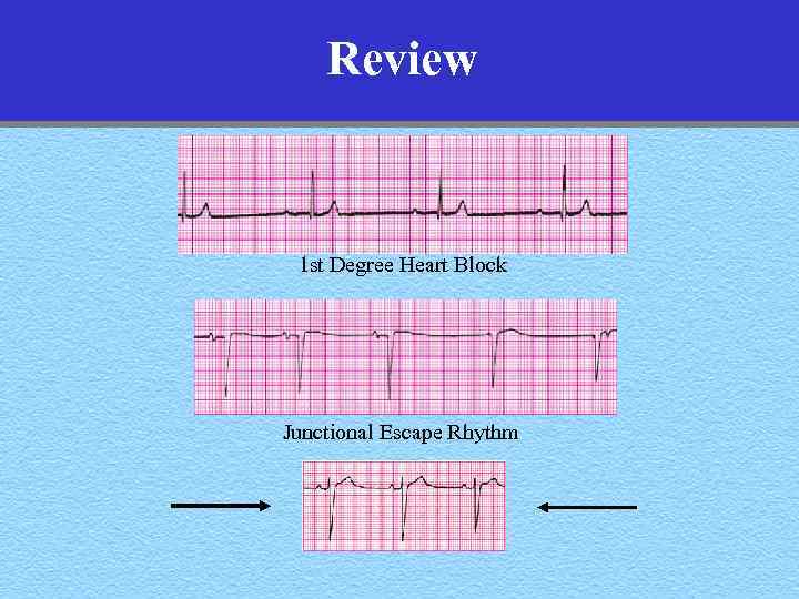 Review 1 st Degree Heart Block Junctional Escape Rhythm 