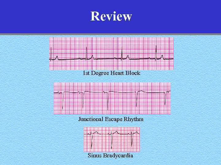 Review 1 st Degree Heart Block Junctional Escape Rhythm Sinus Bradycardia 