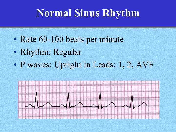 Normal Sinus Rhythm • Rate 60 -100 beats per minute • Rhythm: Regular •